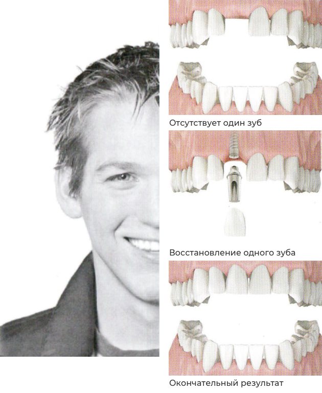 Восстановление одного зуба